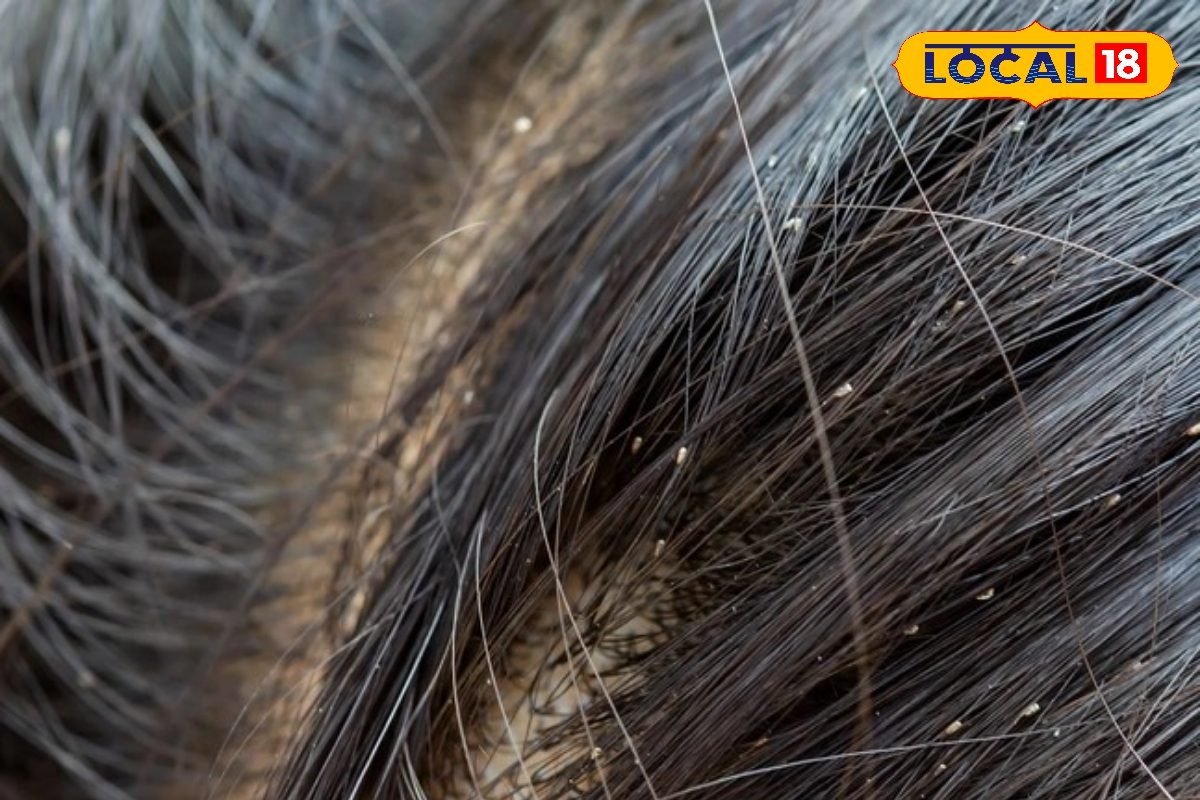 हेल्थ टिप्स: बढ़ती डेंड्रफ की समस्या को नजरअंदाज न करें, ऐसे करें बचाव नही तो हो सकती है त्वचा समस्या!