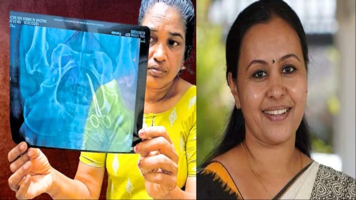 केरल के सरकारी अस्पताल में सर्जरी के समय महिला के पेट में छूटी कैंची, 5 साल तक दर्द में रही पीड़िता: X-Ray से खुला राज, स्वास्थ्य मंत्री ने दिए जाँच के आदेश