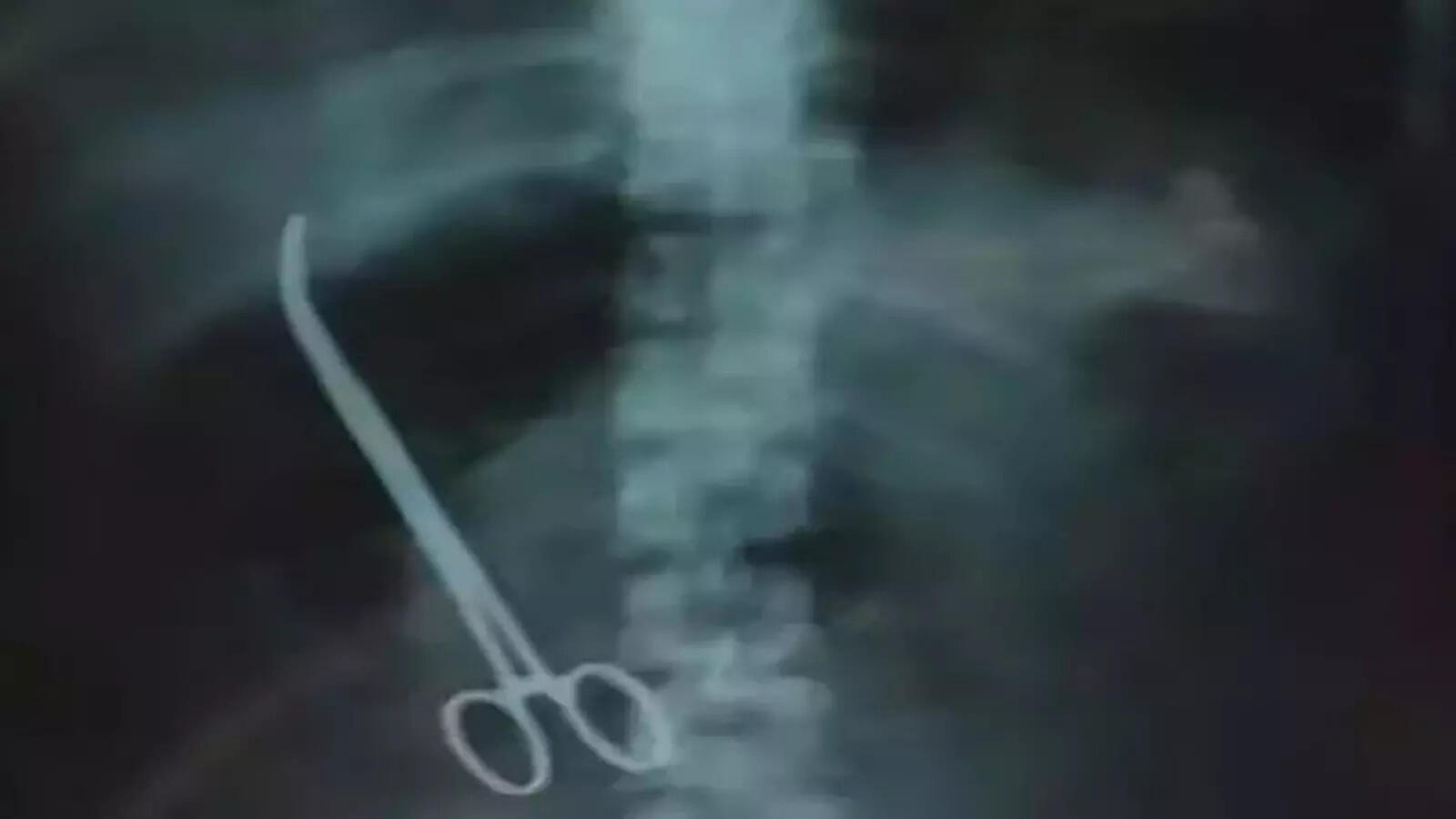 शॉकिंग! 2021 में एक महिला के पेट में रह गया फोरसेप्स, डॉक्टरों ने कहा- इससे कोई समस्या नहीं