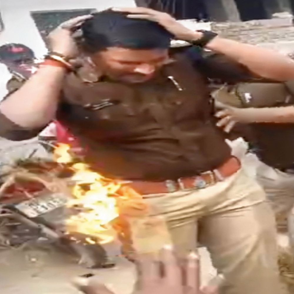 पुतले से झुलसे एसआई, अस्पताल में भर्ती:मंत्री के बयान के विरोध में कांग्रेस ने पुतला दहन कर प्रदर्शन किया