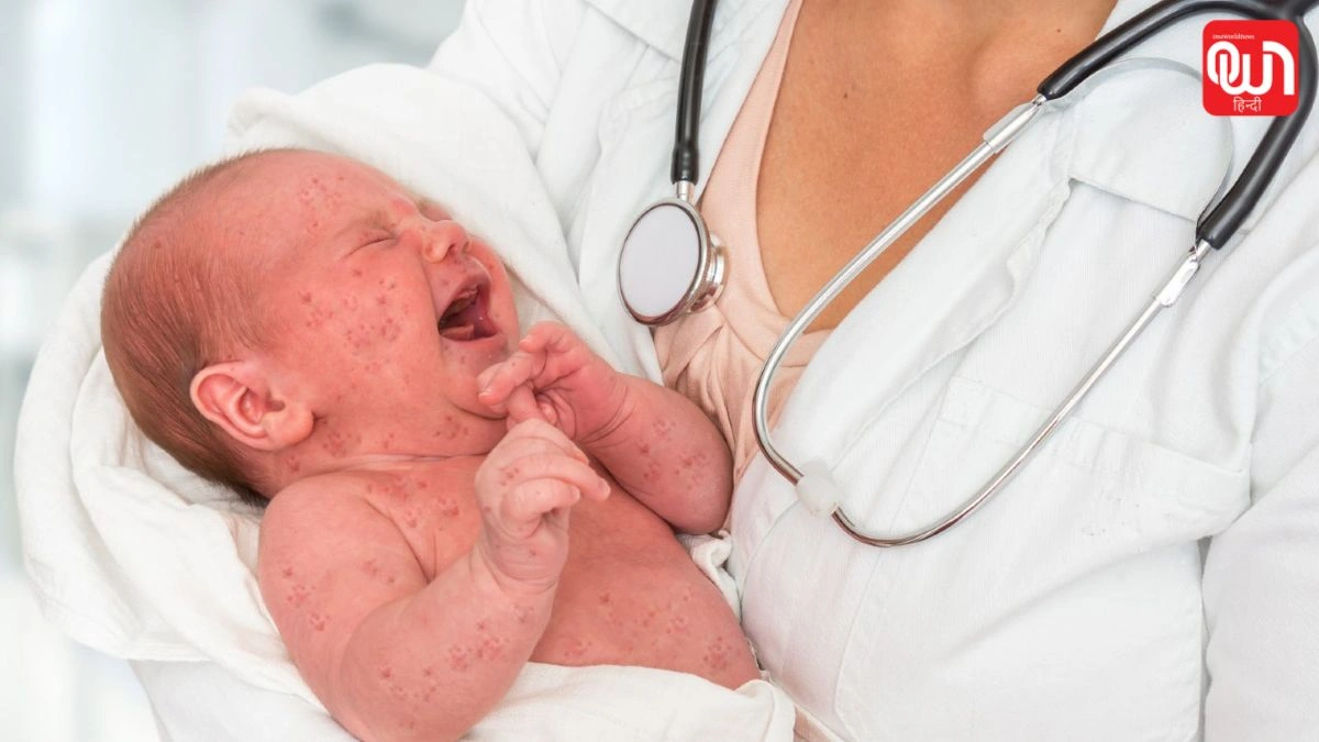 Children Deaths Due To Measles: बच्चों के लिए खतरा, खसरे से कैसे बचें और फैलने से रोकें?