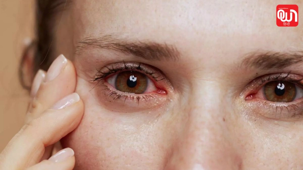 Dry Eye Disease: स्क्रीन टाइम से बढ़ी ड्राई आई, अब मां के दूध का प्रोटीन करेगा कमाल